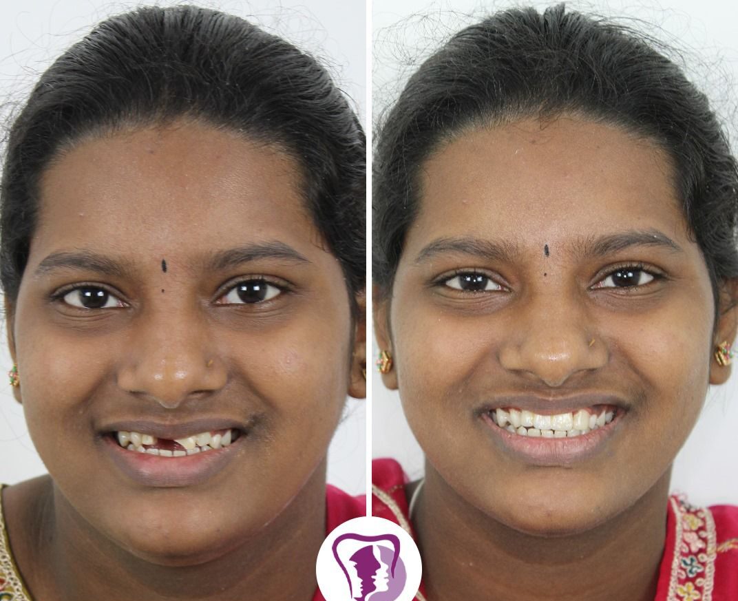 Smile Designing