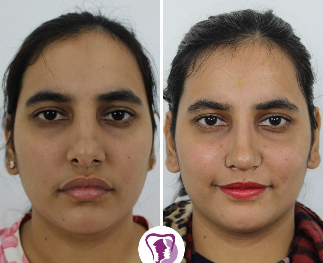 Best Rhinoplasty Treatment In Bangalore, India