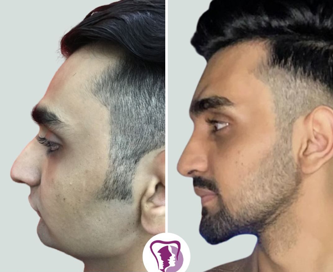 best jaw surgery in India