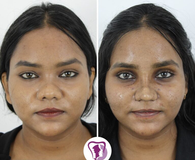 Augmentation Rhinoplasty Treatment In Bangalore, India