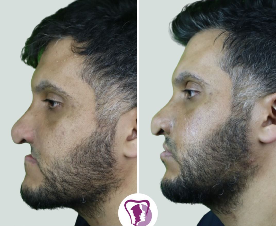 Resurrection Rhinoplasty Treatment In Bangalore, India