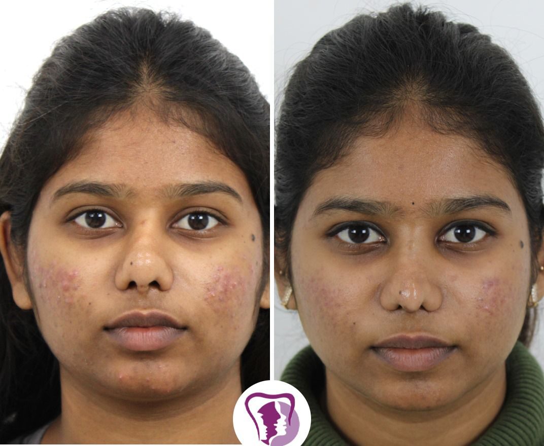 Redo Rhinoplasty Treatment In Bangalore, India