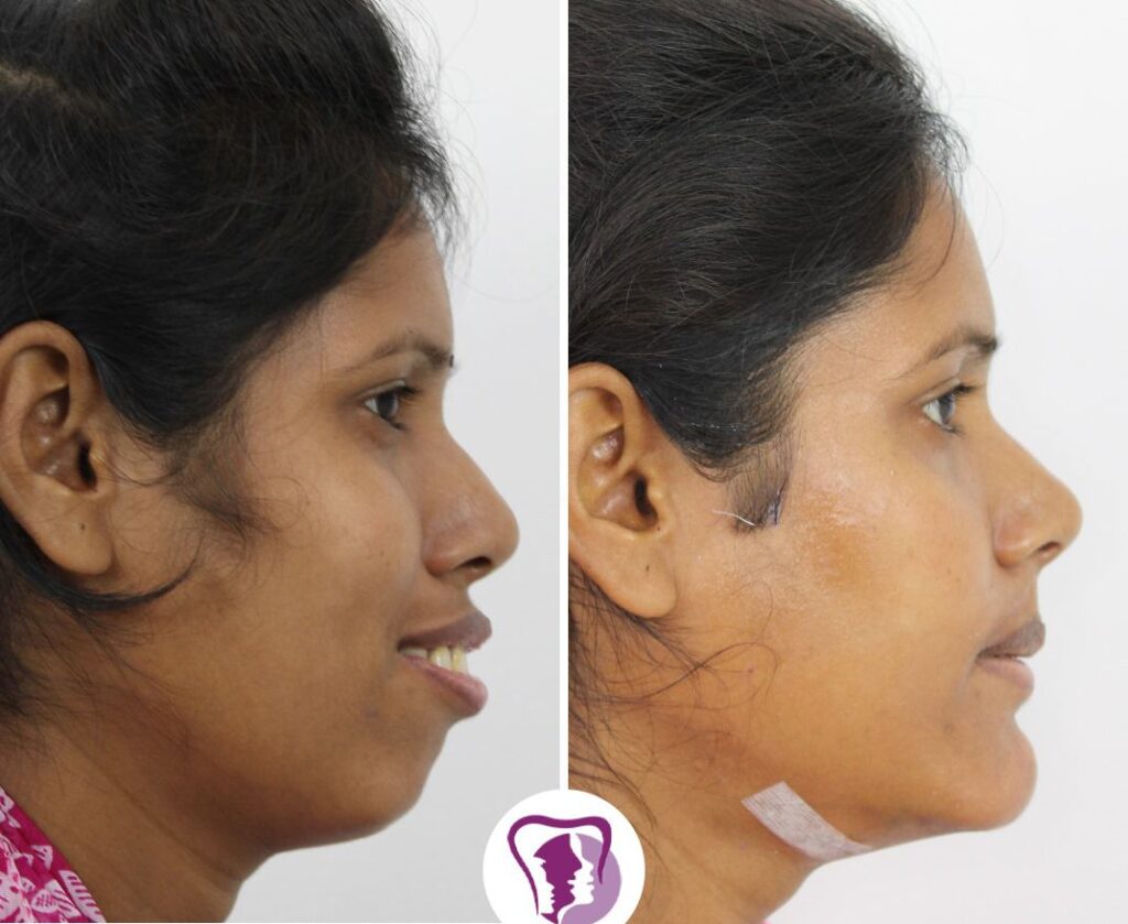 best jaw surgery in India
