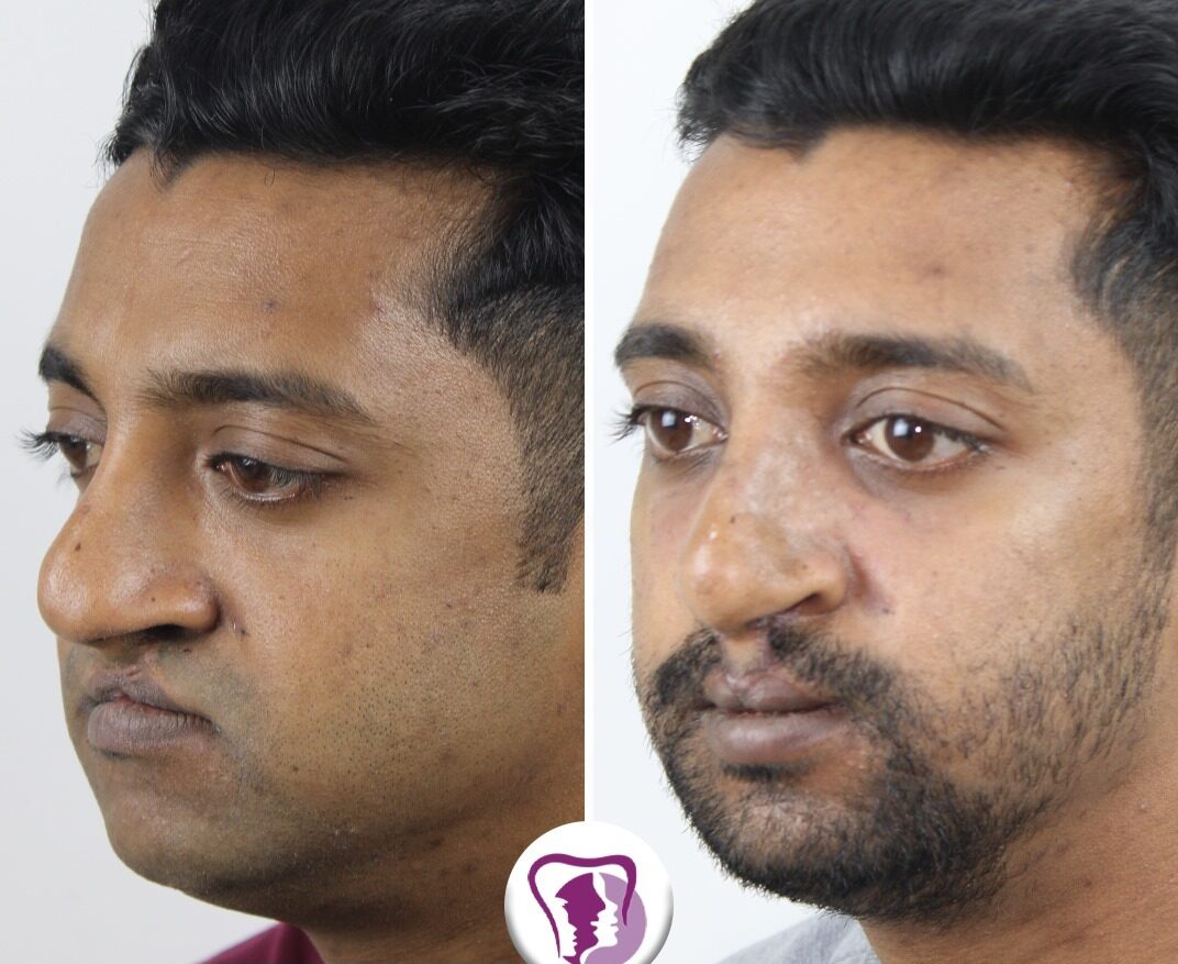 Cleft Lip Repair Surgery