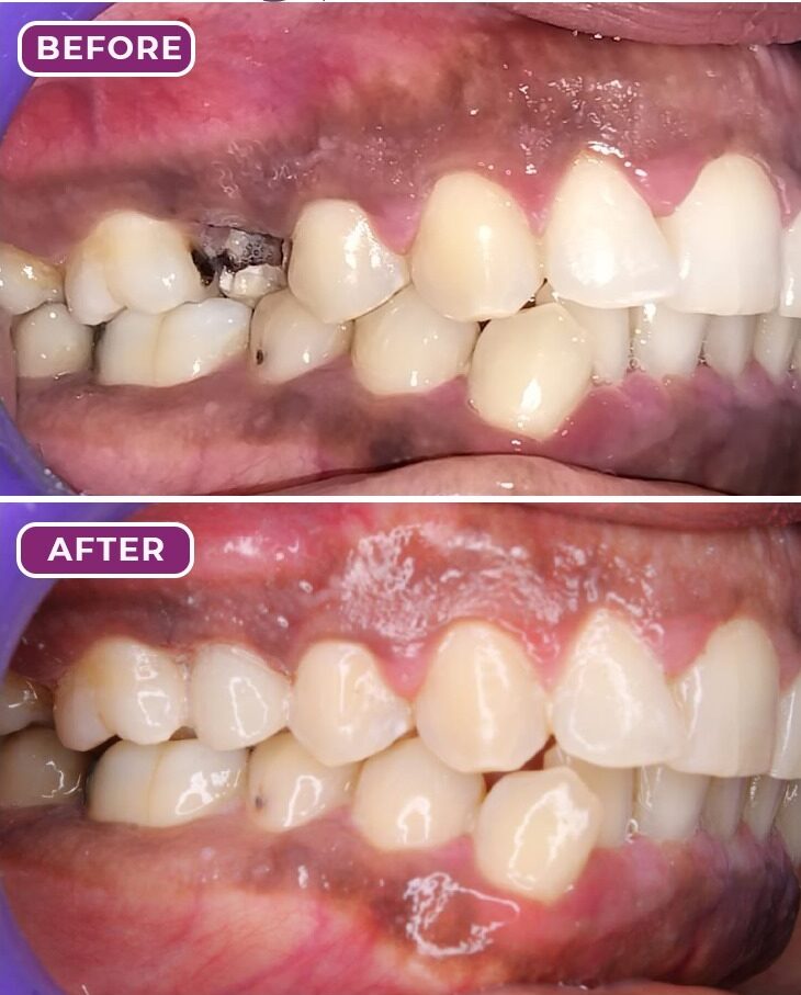 Tooth Colored Restorations