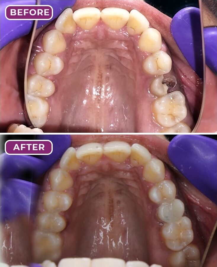 Dental Implants