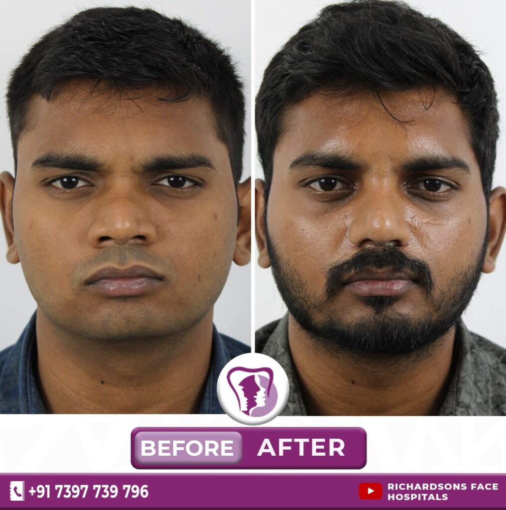Best Chin & Nose job surgery