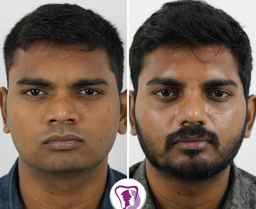 Best Chin & Nose job surgery
