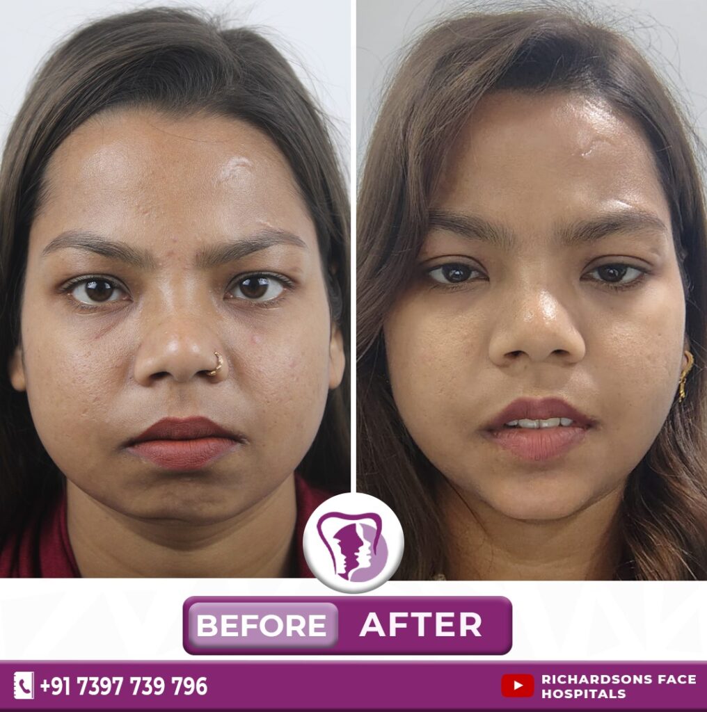 Best Chin Contouring Treatment