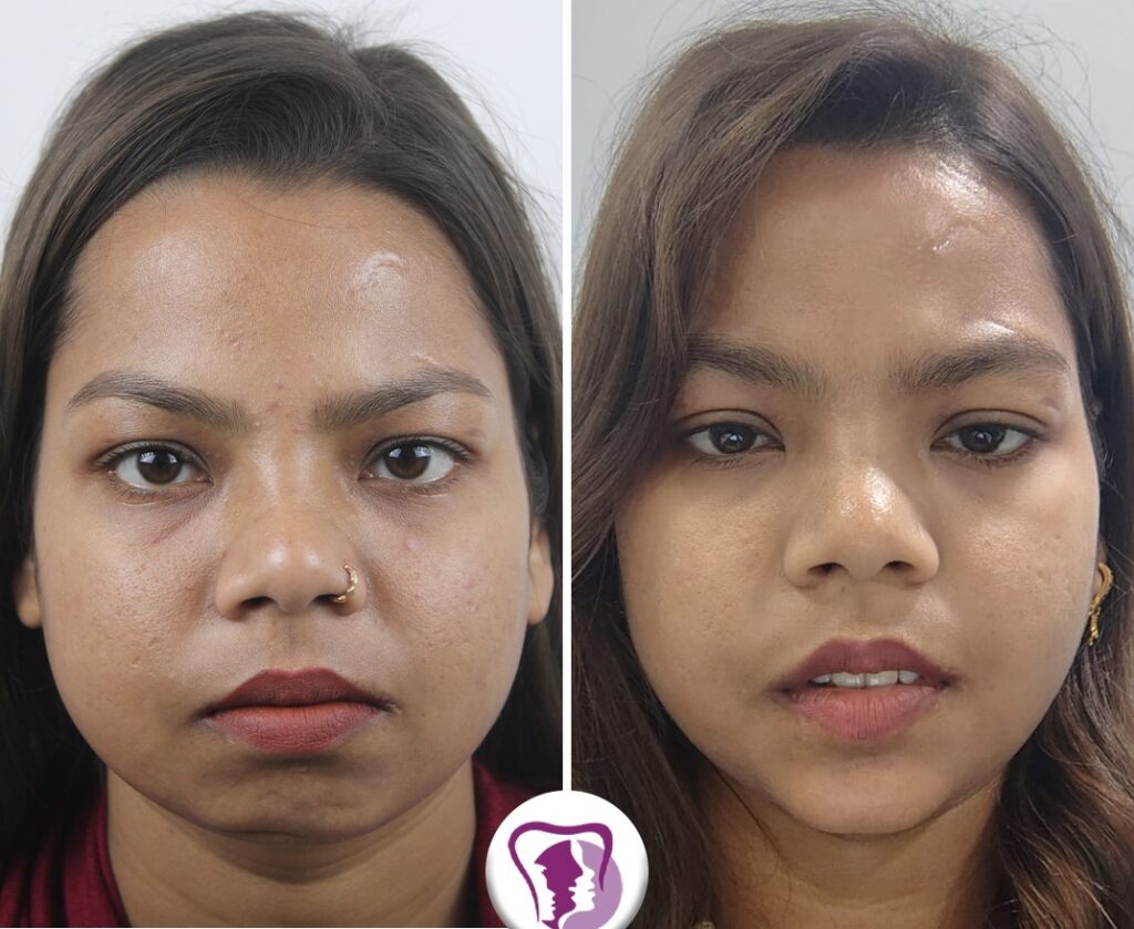 Best Chin Contouring Treatment