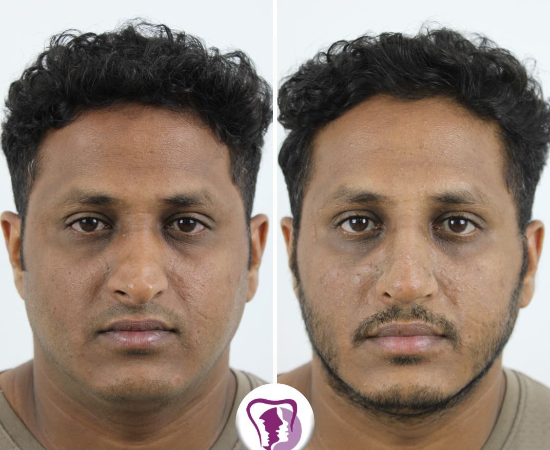 Augmentation Rhinoplasty Treatment In Bangalore, India