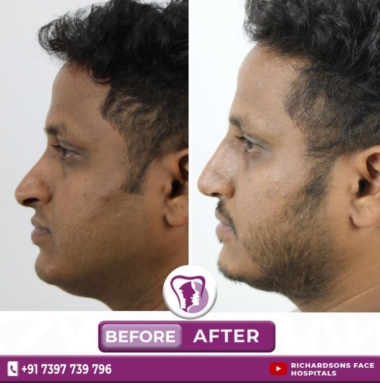 Best Rhinoplasty Treatment In Bangalore, India