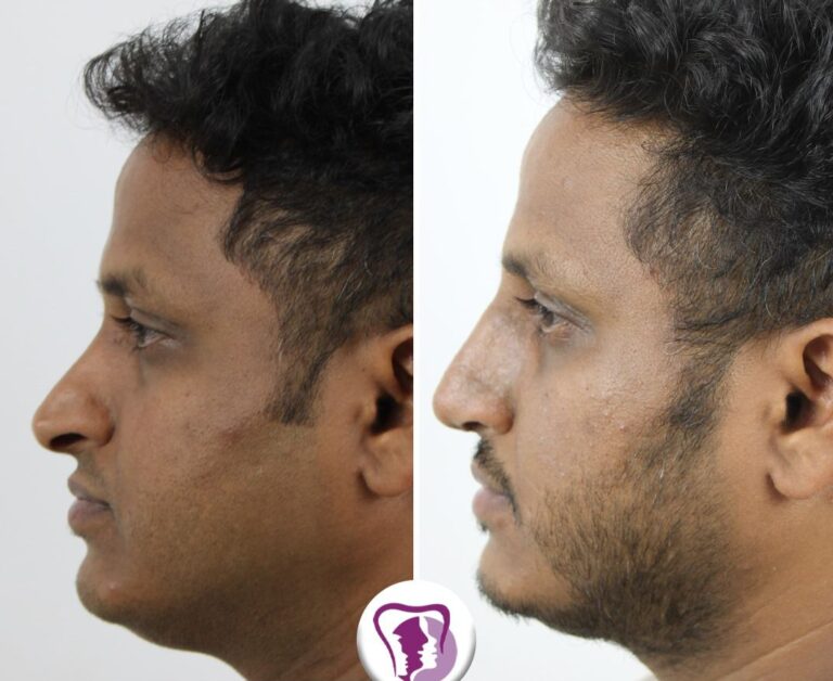 Rib Harvest Rhinoplasty Treatment In Bangalore, India