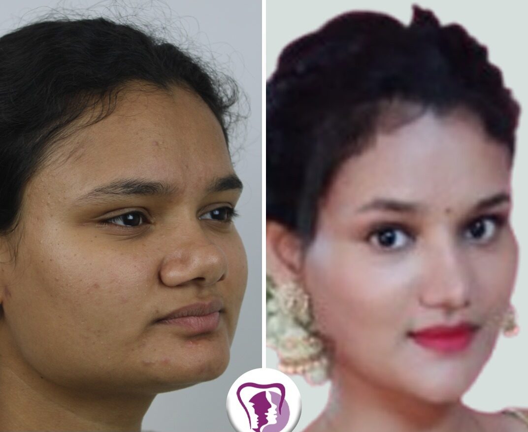 Best Orthogantic Surgery in Bangalore, best jaw surgery in india
