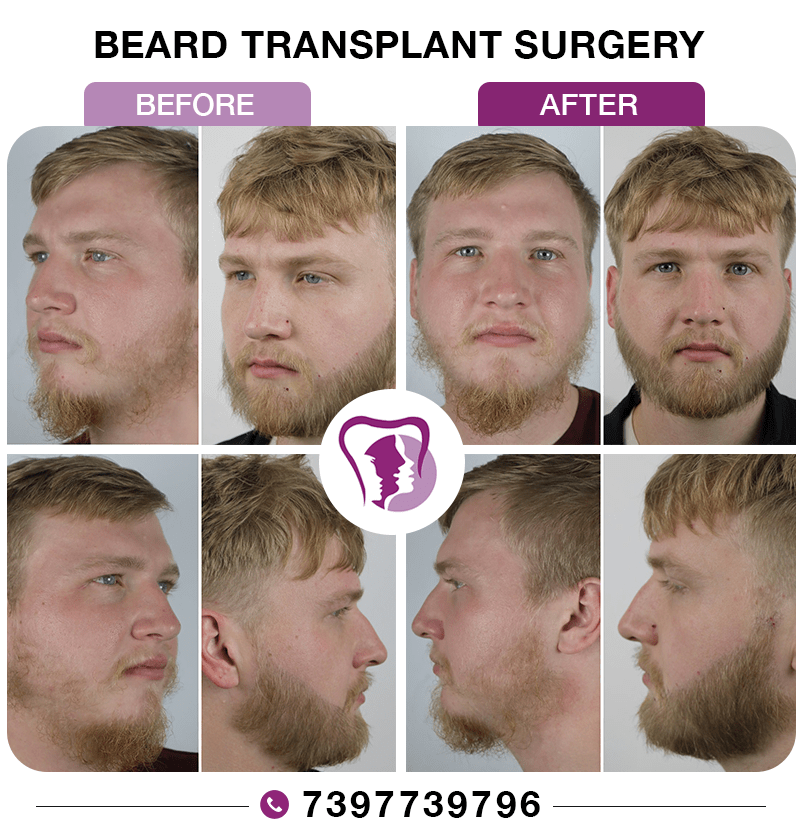 Beard Transplant Surgery
