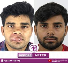 Hemangiomas of the Face