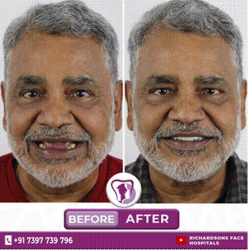 ZYGOMATIC DENTAL IMPLANTS