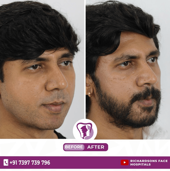 Permanent Beard Transplant Treatment