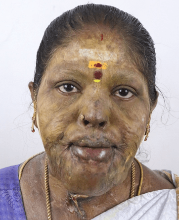 Facial Burn Injuries