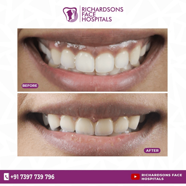 gummy smile treatment