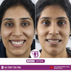 Gummy Smile Treatment