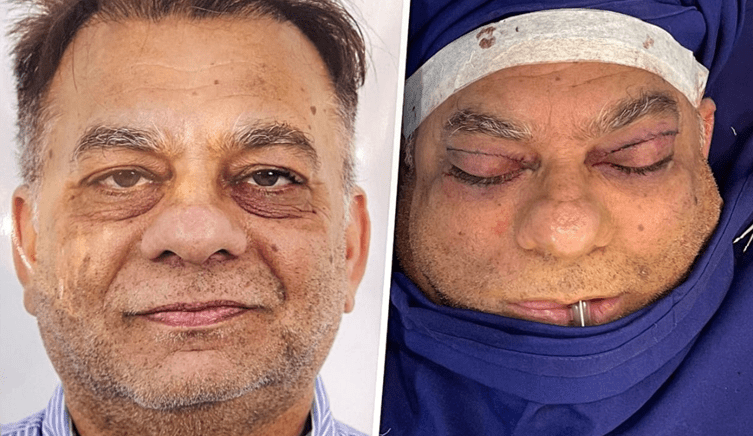 Everything to know before Blepharoplasty