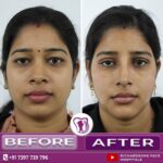 Nosejob with Genioplasty Female Face before & after