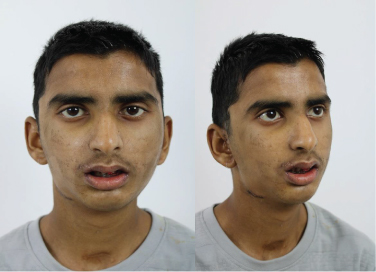 Temporomandibular Joint