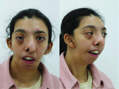 Female Face Golden-Har Syndrome Pre-OP