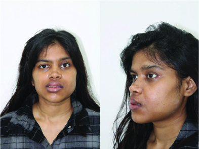 Female Face Hemifacial Microsomia Post-OP (7th Day) which is one of the Major Congenital Syndromes