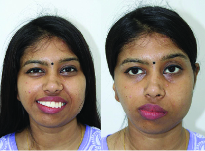 Orthognathic Surgery in Major Congenital Syndromes