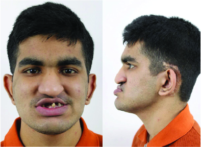 Case #1 Male Patient Pre-OP