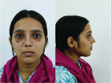 Case #2 Female Patient Post-OP