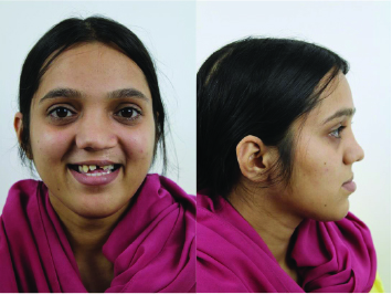 Case #2 Female Patient Pre-OP