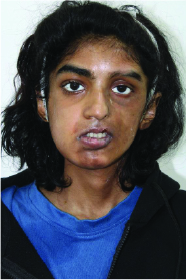 Parry-Romberg Syndrome Female Patient Post-OP