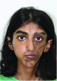 Parry-Romberg Syndrome Female Patient Pre-OP