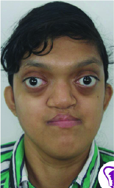 Crouzon Syndrome Case #1 Patient Pre-OP