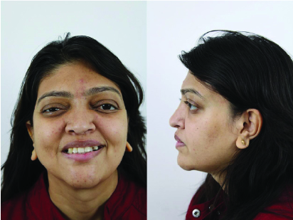 Crouzon Syndrome Case #2 Female Patient Post-OP