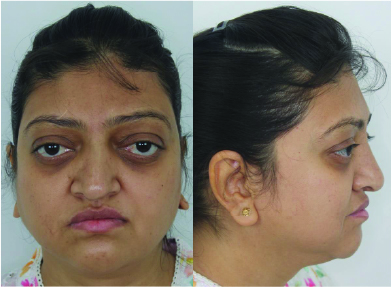 Crouzon Syndrome Case #2 Female Patient Pre-OP