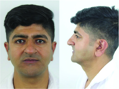 Binders Syndrome Male Patient Post-OP