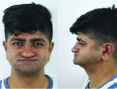 Binders Syndrome Male Patient Pre-OP