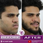 02 Orthognathic Surgery 2