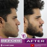 02 Orthognathic Surgery 3