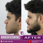 02 Orthognathic Surgery 4