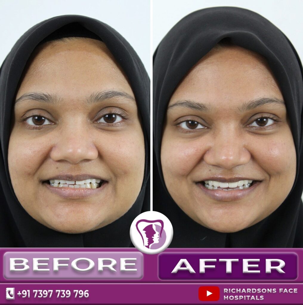 Digital Smile Designing: After