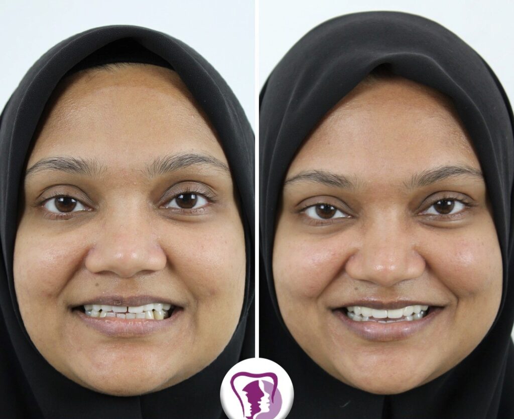 Dental Smile Designing