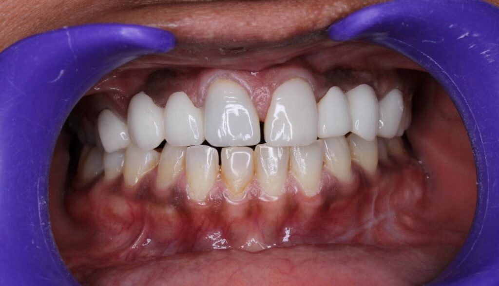 Digital Smile Designing: Before