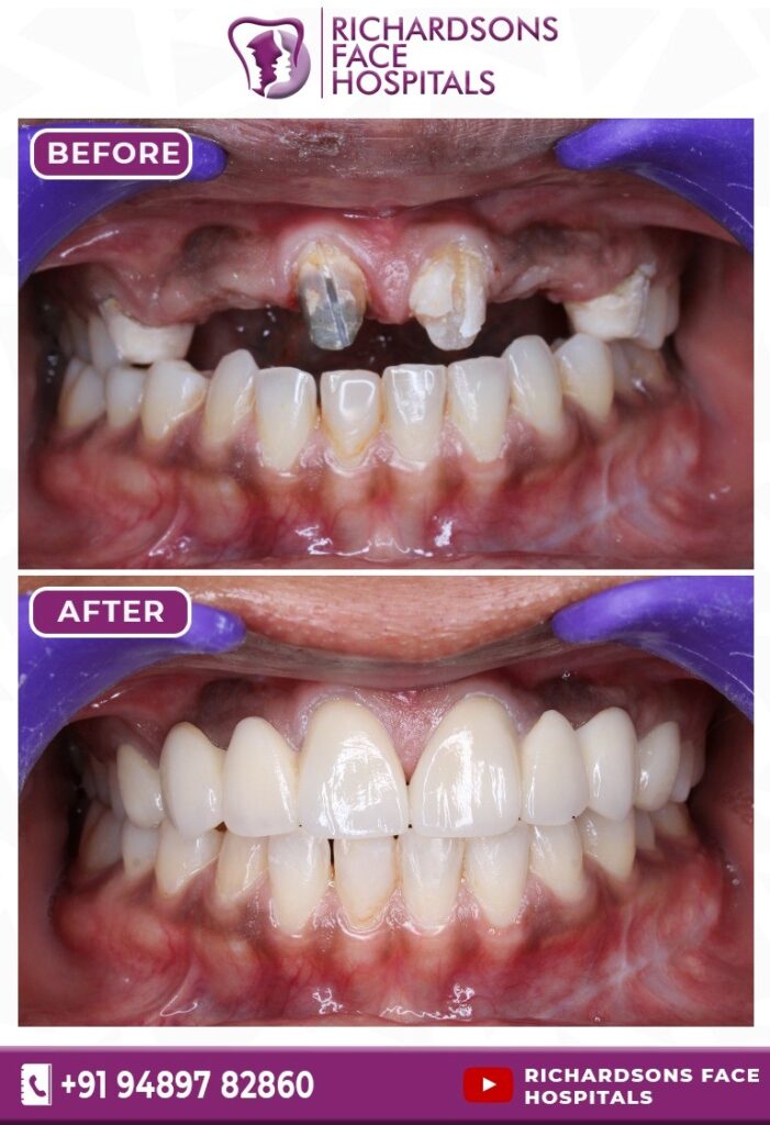 Digital Smile Designing: Before