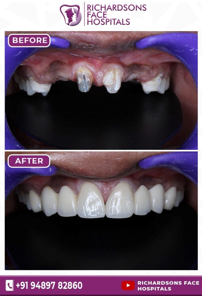 Digital Smile Designing: Before