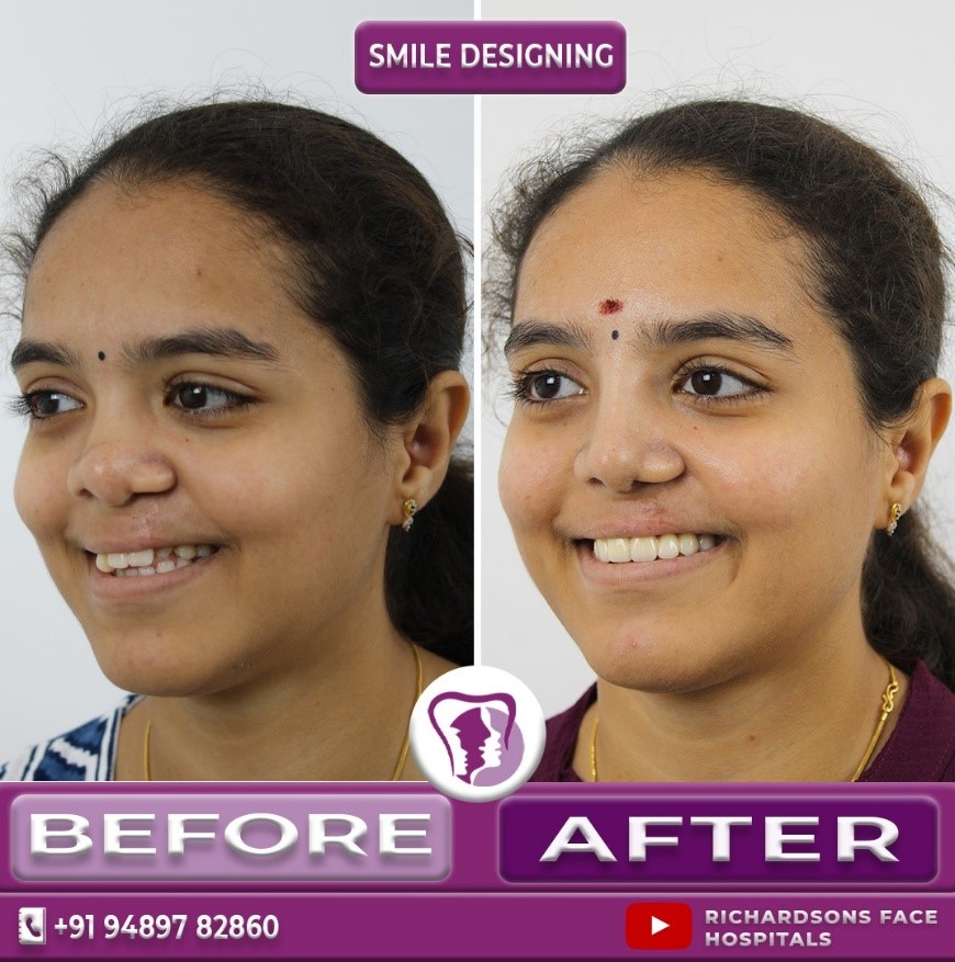 Female Digital Smile Designing: Before & After